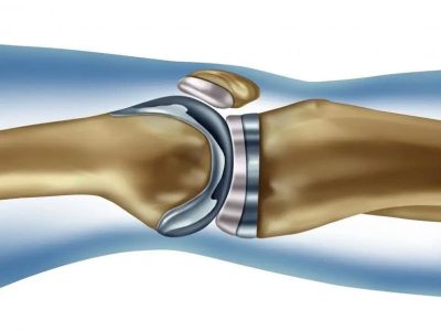 Should I replace the joint and maintain it?