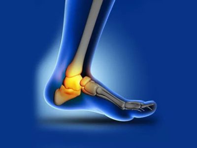 Ankle arthritis and its treatment