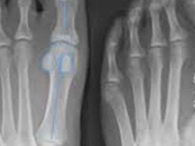 Surgery to treat tumors in the toe