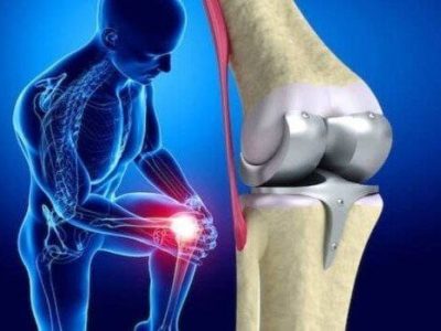 Is minimally invasive knee replacement surgery right for you?