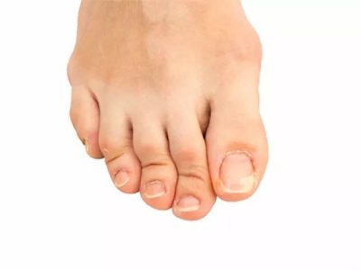 Hammertoe and Painful Toe Deformities