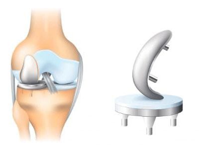 When is a partial knee replacement surgery necessary?