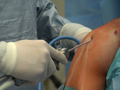 Is surgery necessary for rotator cuff injury?