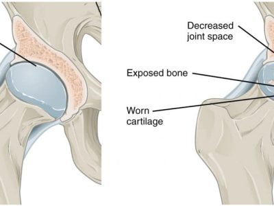 Synovial Chondromatosis: Causes, Symptoms, Diagnosis, and Treatment