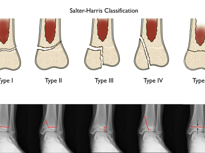 Understanding Pediatric Ankle Fractures: Causes, Treatment, and Recovery