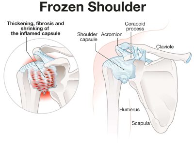 Frozen Shoulder