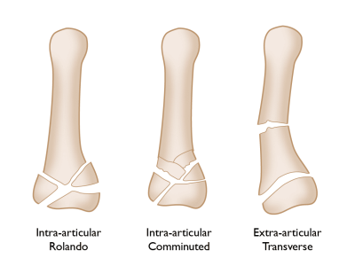 Understanding Thumb Fractures: Risks, Recovery, and Long-Term Impacts