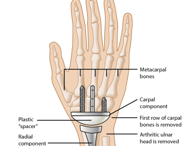 “Understanding Wrist Arthroplasty: A Solution for Severe Wrist Arthritis”